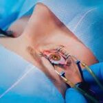 Especialista explica como cirurgia de catarata pode mudar a qualidade de vida dos pacientes